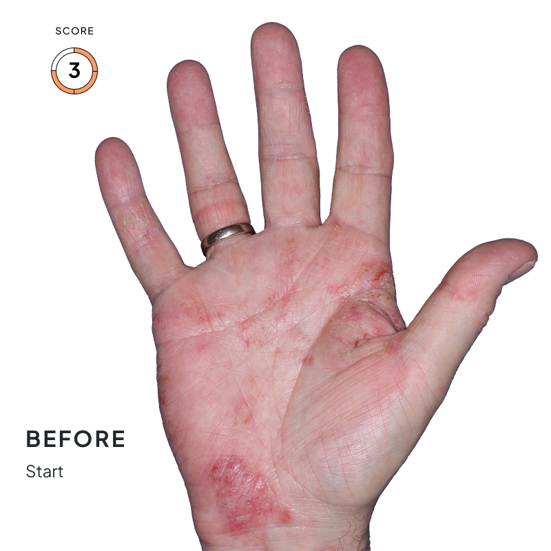 Before-and-after image of a hand showing skin improvement after 4 months of Anzupgo® treatment