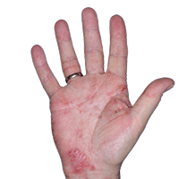 Small thumbnail of hand showing redness and irritation before Anzupgo® treatment