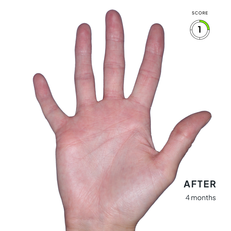 Before-and-after image of chronic hand eczema showing improvement from score 4 to 1 after 4 months of Anzupgo® treatment