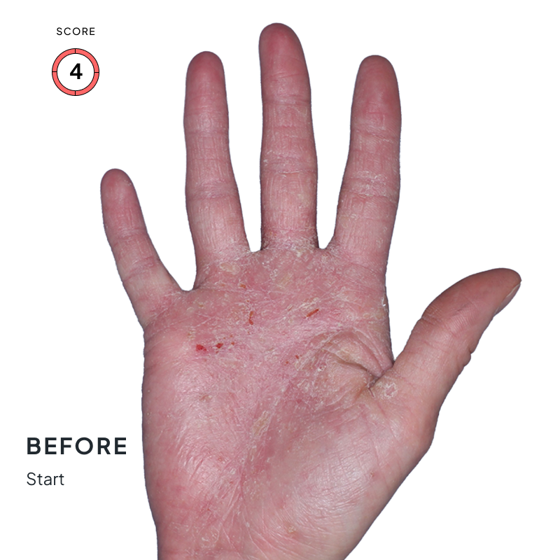 Before-and-after image of chronic hand eczema showing improvement from score 4 to 1 after 4 months of Anzupgo® treatment