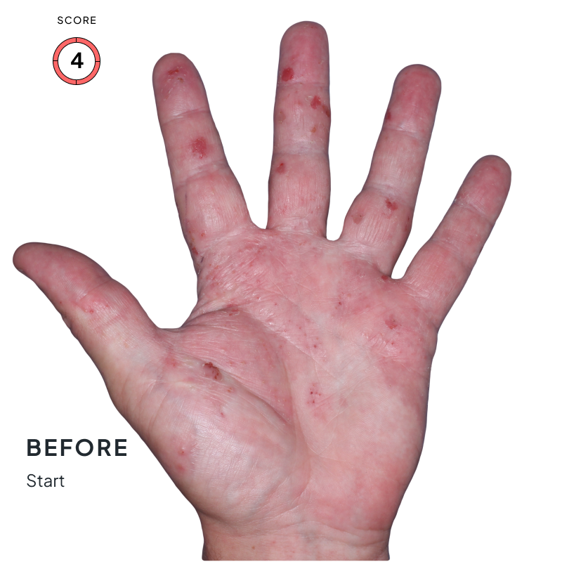 Before-and-after image of chronic hand eczema showing improvement from score 4 to 0 after 4 months of Anzupgo® treatment