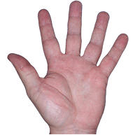 Small thumbnail of hand showing redness and cracked skin before Anzupgo® treatment
