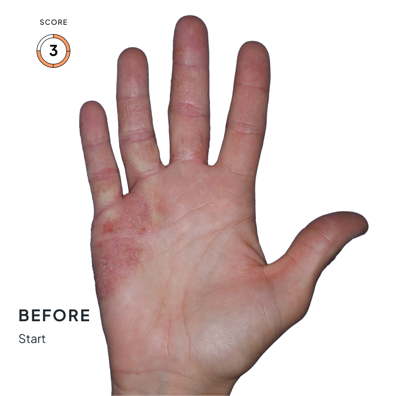 Before-and-after comparison showing chronic hand eczema improvement from score 3 to score 1 after 4 months of Anzupgo® treatment