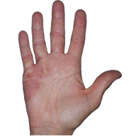 Hand showing chronic eczema with visible inflammation and scaling on palm and fingers